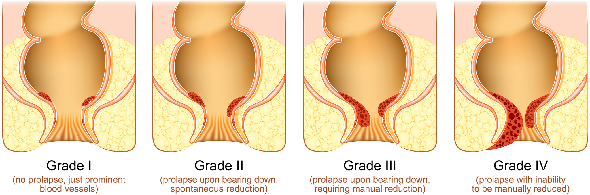 Hemorrhoid Grading System: Grade 1 to 4 Explained