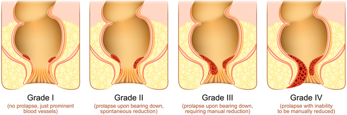 Hemorrhoid Grading System: Grade 1 to 4 Explained